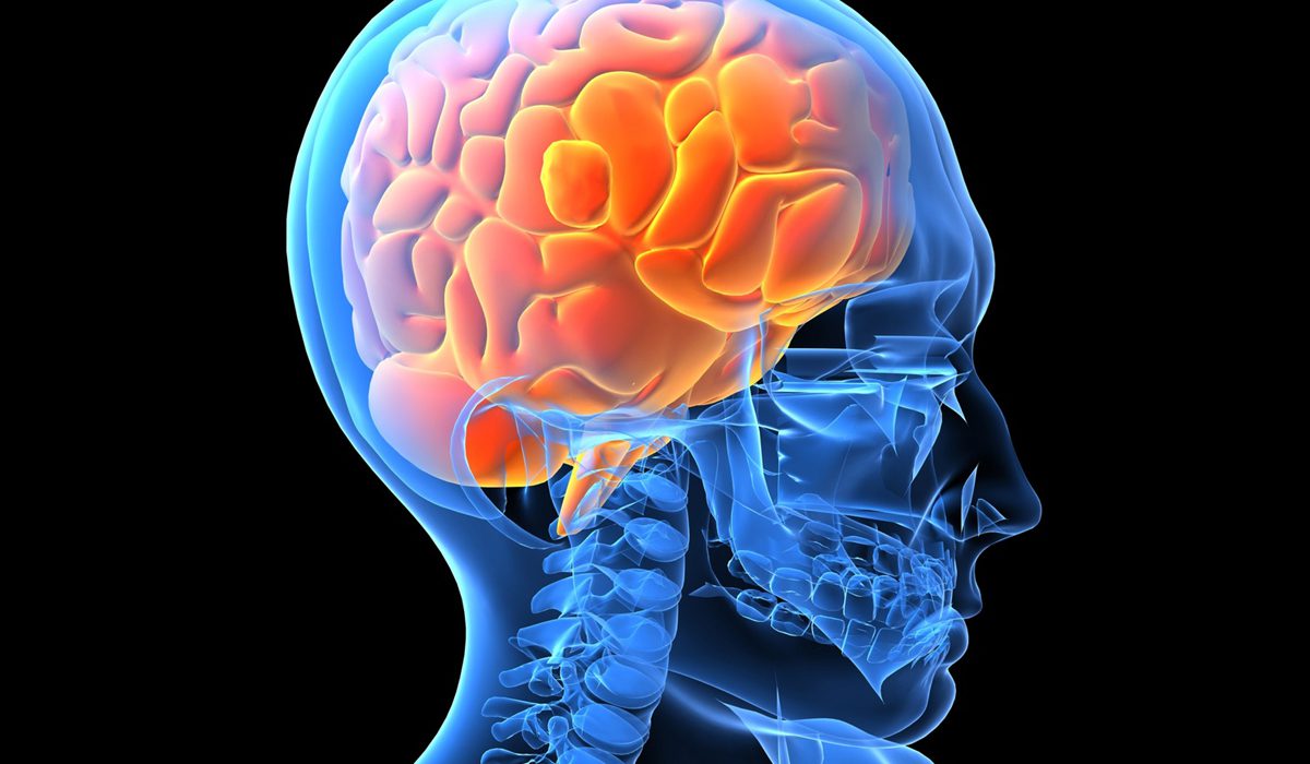Men with Alzheimer’s gene at risk of brain bleeding, study finds
