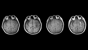 Brain scans taken 1, 2, 7, and 12 days (left to right) after a traumatic brain injury show how an injury can continue to develop and worsen for weeks after the initial trauma (click to enlarge image).