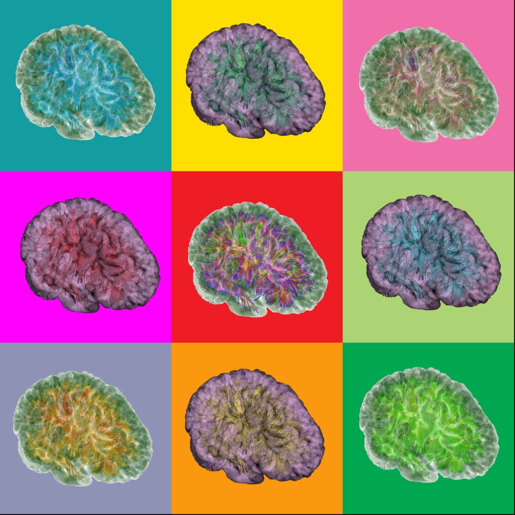 Brain changes from Alzheimer's