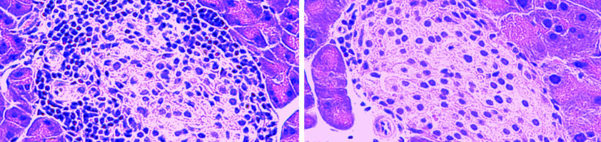 "Killer" T-cells (small dark purple spots) infiltrate the pancreatic islet in mouse model of type 1 diabetes (left); MOTS-c treatment prevents autoimmunity and the development of the disease (right)